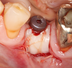 2026-12-04/05th - Dental Implant Soft Tissue Plastics Course