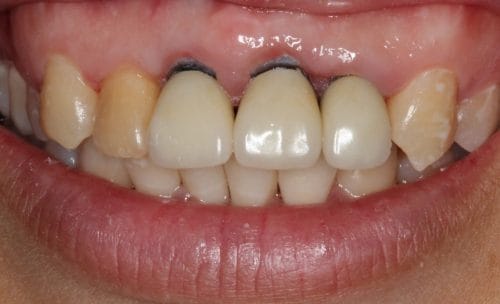 Surgical Management of Periodontitis and Crown Lengthening